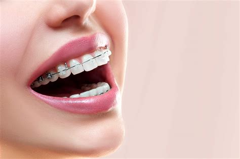 metal bracket behind teeth|best braces for adult teeth.